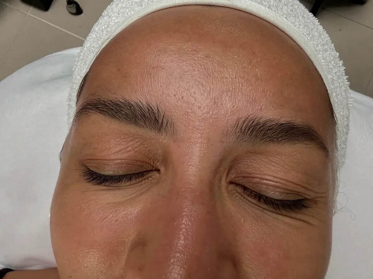 Eye contour and upper eyelids, one of the areas treated with Plasmapen in Málaga